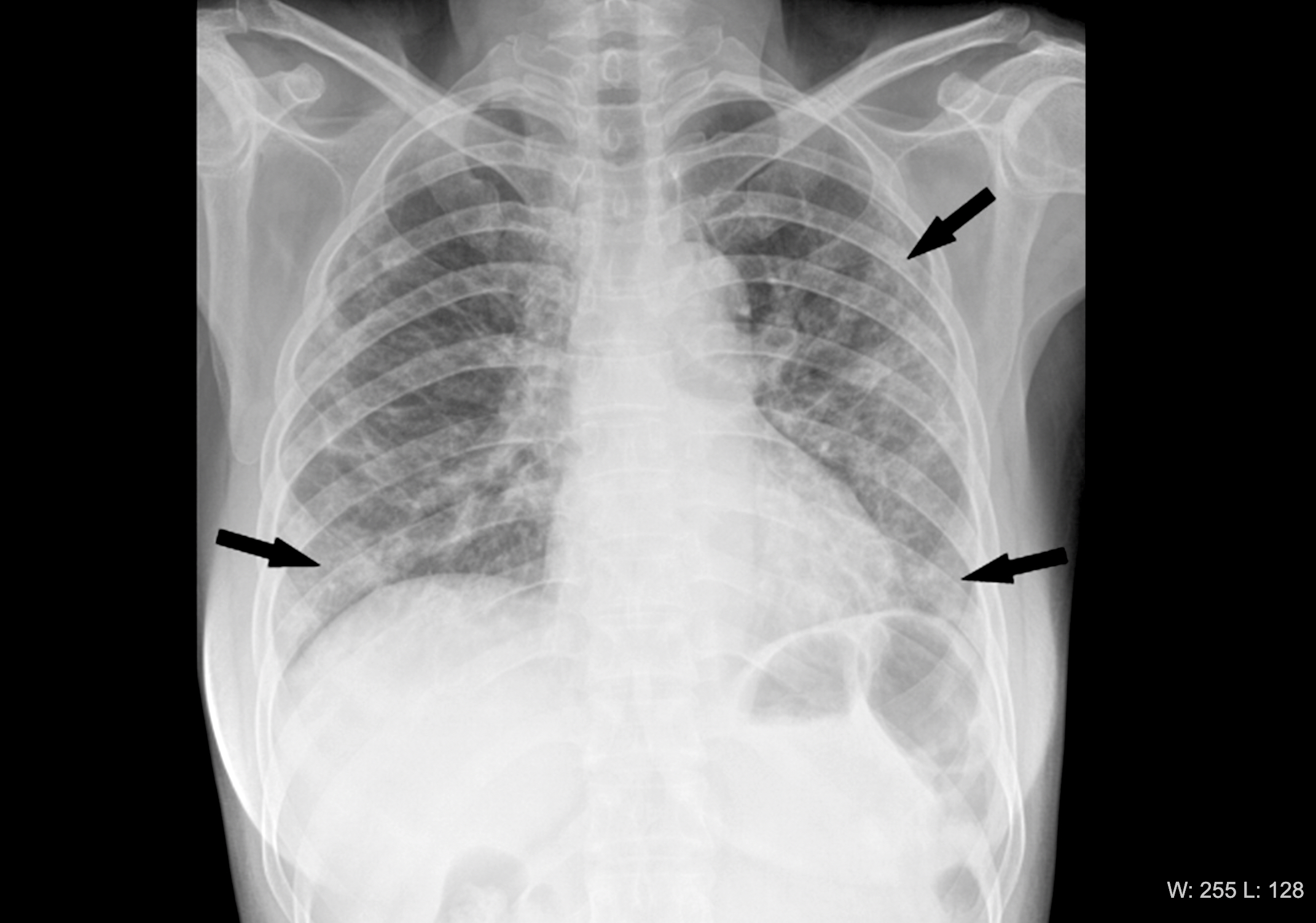 поражение легких при коронавирусе фото рентгена